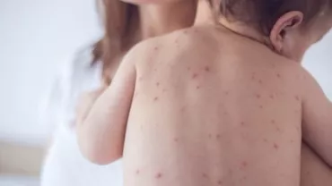 EPIDEMIA DE RUJEOLĂ! Mii de COPII din 41 de județe, INFECTAȚI