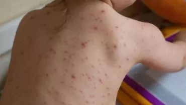 Epidemia de rujeolă mai face o victimă, a 34-a - Un băiețel de doar 5 luni din județul Neamț