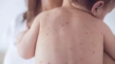 Zeci de noi cazuri de rujeolă în țară: București și județul Ialomița, cele mai afectate zone 