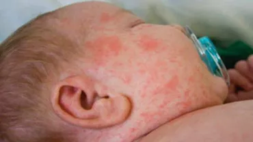 Cazurile de RUJEOLĂ s-au răspândit în aproape toată Prahova. 20% dintre bolnavi erau VACCINAȚI!