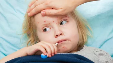 Statistici ALARMANTE: ROMÂNIA, focarul infecțiilor cu RUJEOLĂ din Europa