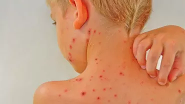 Târgu-Jiu: FOCAR de varicelă la o GRĂDINIȚĂ! Zeci de copii INFECTAȚI! INFORMAȚII DE ULTIM MOMENT