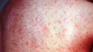 Bilanţ ÎNGRIJORĂTOR: 215 cazuri noi de rujeolă au fost confirmate în ultima săptămână