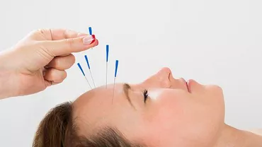 ACUPUNCTURA, O SOLUTIE PENTRU INSOMNII?