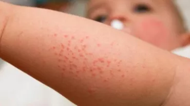 Epidemie de RUJEOLĂ: Un copil de 4 ani a murit. Este al 50-lea deces