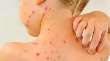 Cum e tratat un caz de rujeolă în SUA: Alertă într-un întreg stat american din cauza unui pacient contaminat 
