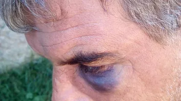 Un bărbat a fost bătut crunt de primarul și viceprimarul unei comune din Brașov: `Asta e PSD. Ăștia sunt cei care ne conduc` (FOTO)