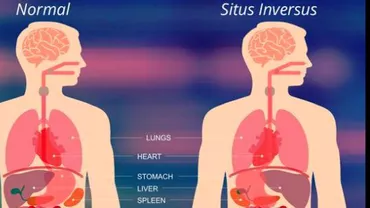 Femeie cu organele interne dispuse invers, operată la Spitalul din Suceava