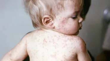 Epidemia de rujeolă se extinde! Alte 85 de cazuri confirmate în România