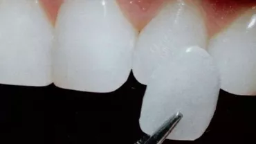 Cea mai nouă metodă de a fura oamenii: Fațetele dentare. Sute de creduli cad în plasa șarlatanilor