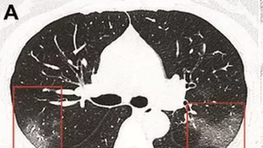 Incredibil! Cum arată PLĂMÂNII unei tinere din China infectată cu CORONAVIRUS. Medicii au făcut PUBLICĂ RADIOGRAFIA. Virusul acționează RAPID (FOTO)