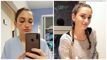 Asistentă din 'zona-zero' a Italiei, cu răni pe față cauzate de măştile chirurgicale. Mesajul emoționant transmis de ea către cei din afara spitalului. 'Mi-e teamă' (FOTO)