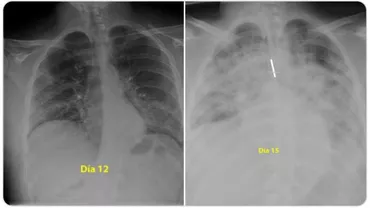 Cum arată plămânii unui tânăr infectat cu noul coronavirus: La 28 de ani a fost intubat în trei zile (FOTO)