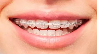 5 lucruri pe care trebuie să le știi înainte de a-ți pune aparat dentar