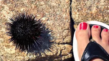 Spaima turiștilor care merg pe litoral: Ce trebuie să faci dacă te-a înțepat ariciul de mare