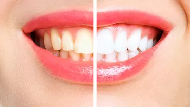 Care sunt diferențele dintre restaurarea dentară și estetica dentară