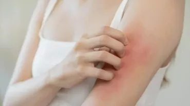 Cum tratezi iritaţia de la căldură / Sfaturile medicilor pentru zile caniculare