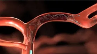 Trombectomia, procedura de tratare a accidentului vascular cerebral / Este disponibilă în doar 9 spitale din România