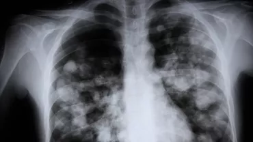 „Sindromul plămânului alb, tot mai mult în atenția medicilor / Specialiștii avertizează asupra simptomelor severe