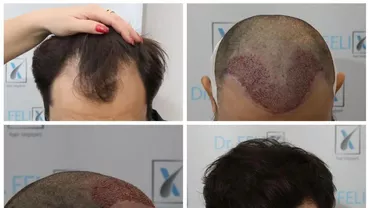 Te confrunți cu alopecia? Detalii despre implant de par Q-FUE manual la Dr Felix Hair Implant