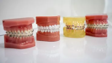 De ce să alegi aparatul dentar invizibil SPARK pentru un zâmbet perfect