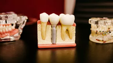 Coroana dentară pe implant: Etape și tipuri de materiale