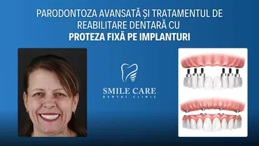 Parodontoza avansată și tratamentul de reabilitare dentară cu proteza fixă pe implanturi