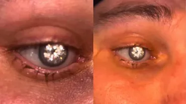 Un bijutier din Alabama a decis să-și facă o schimbare de look: „Mi-am pus un diamant de 2 milioane de dolari în loc de ochi”
