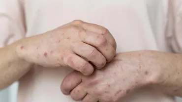 Cazuri de varicelă tot mai multe în rândul adulților. De ce boala copilăriei devine un pericol neașteptat